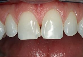 Cameron Park Dental Care | Ceramic Crowns, TMJ Disorders and Periodontal Treatment